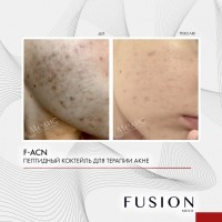 F-ACN (Коктейль для лечения акне), 1 шт x 10 мл