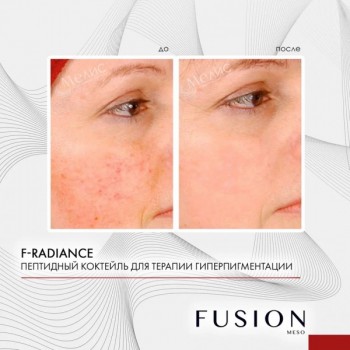 F-RADIANCE (Коктейль для лечения пигментации), 1 шт x 10 мл